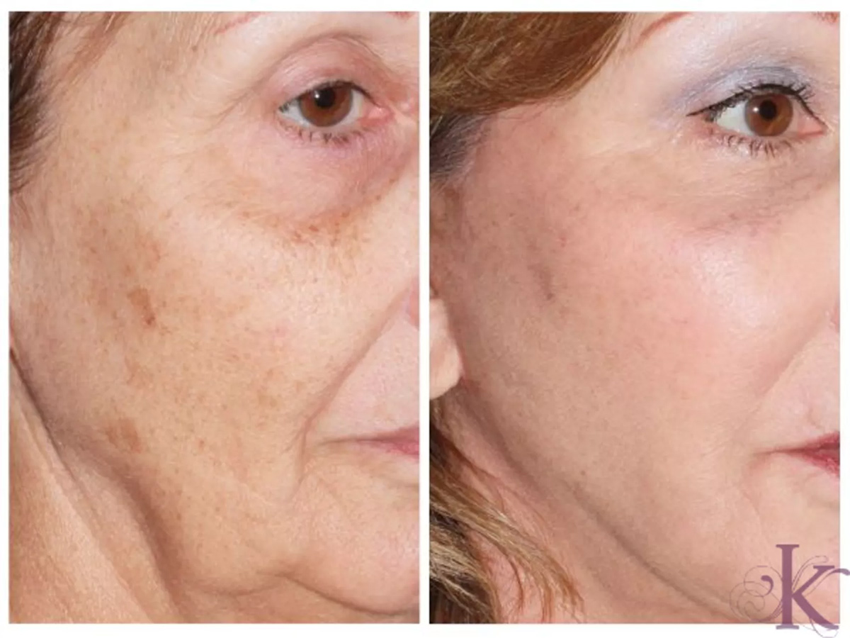 Before & After Skin Resurfacing Case 43 View #1 View in NYC New York, NY